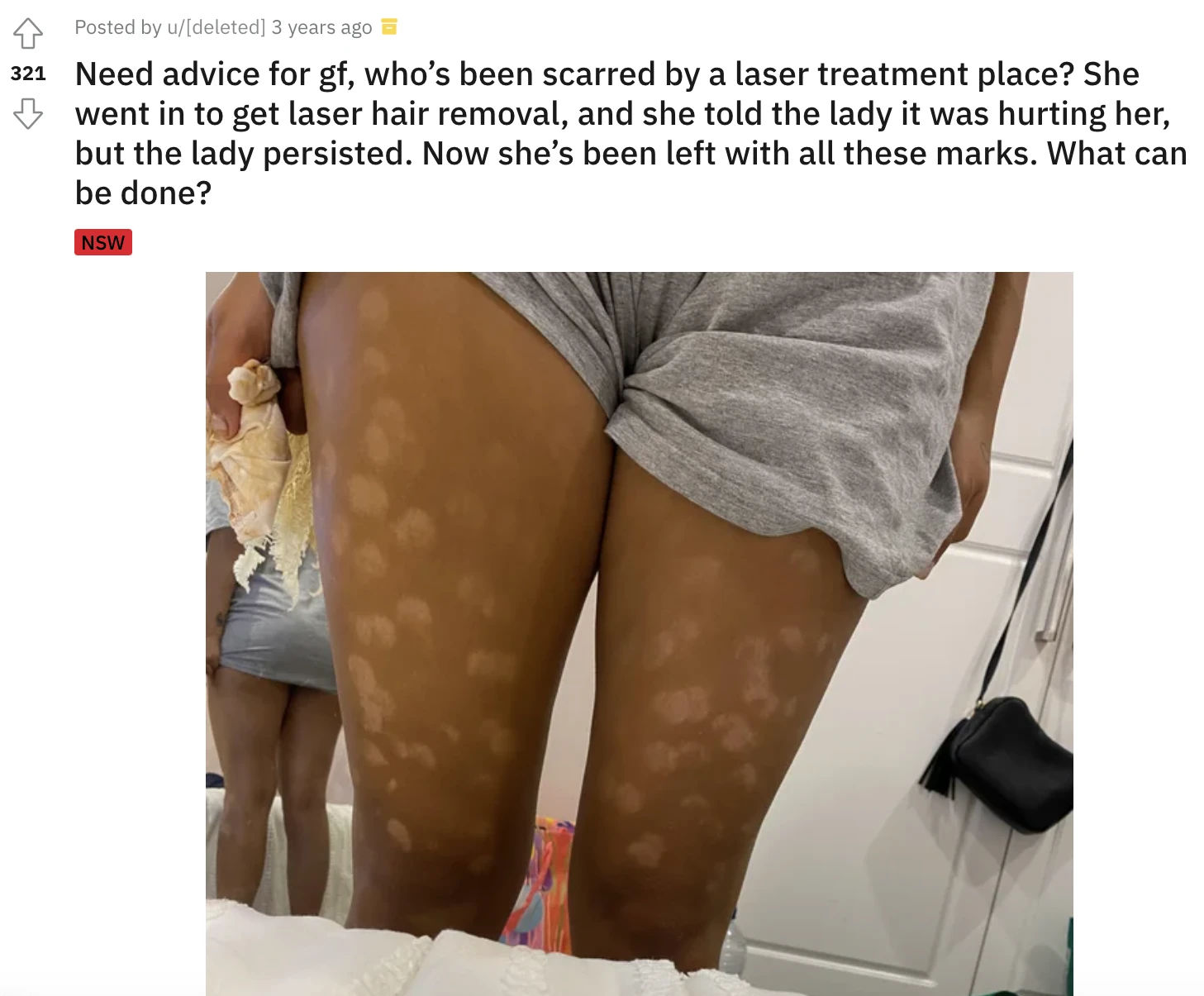 Exemple d’un cas de dépigmentation suite à un traitement au laser sur peau noire. (Source : Reddit)
