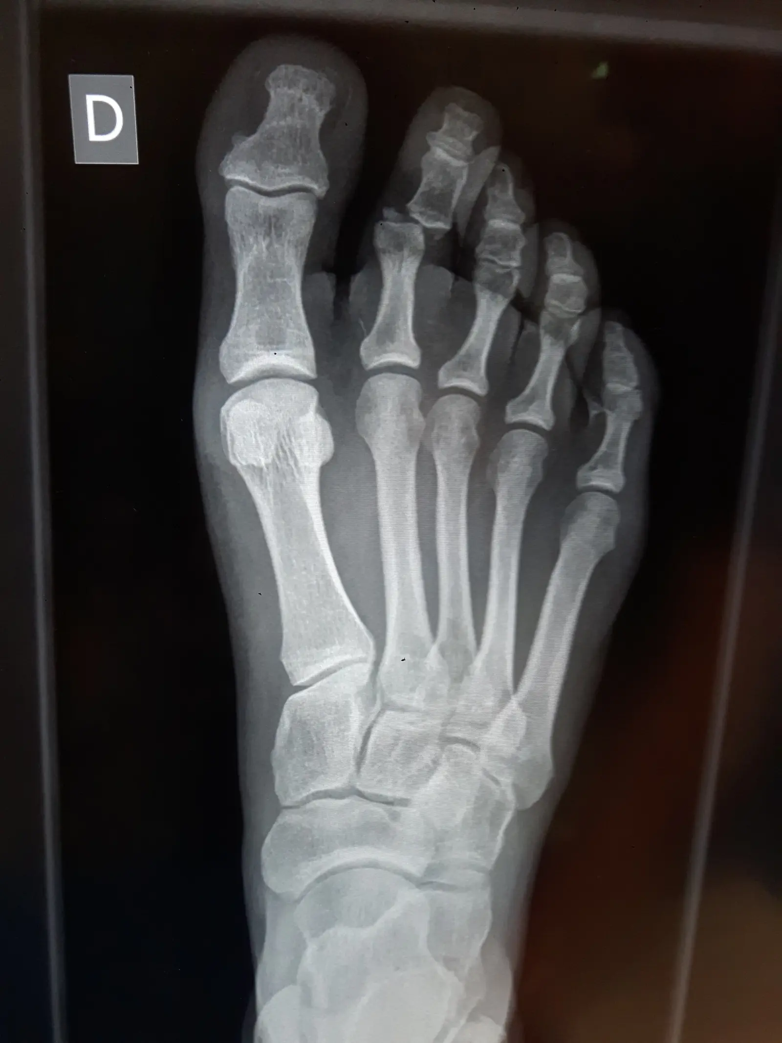 Un pied amoché. Photo : Louis-Princesse.